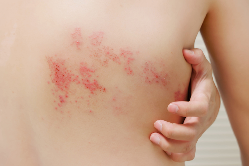 Shingles Symptoms rash on woman&#x27;s back