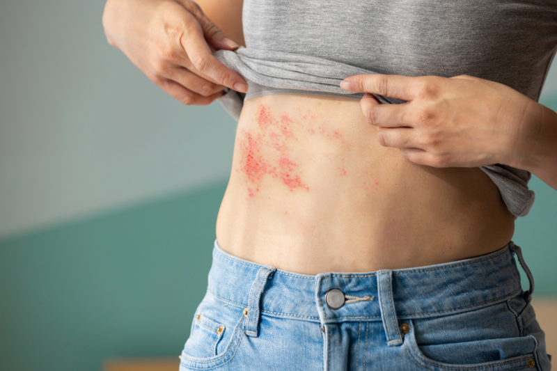 Shingles symptoms rash on woman&#x27;s stomach